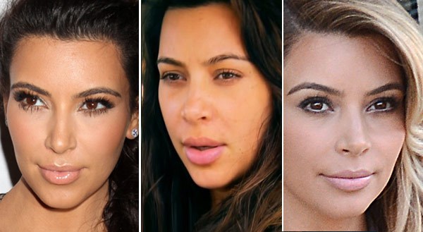 Kim Kardashian Lip Implant
