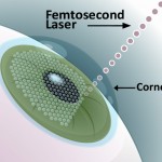 Laser Femtosecond Surgery Procedure