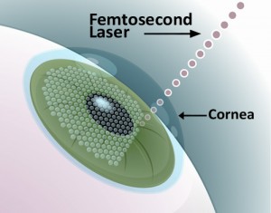 Laser Femtosecond Surgery Procedure