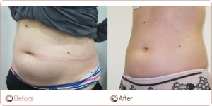 Fat Reduction Surgery