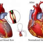 Heart Surgery Risk