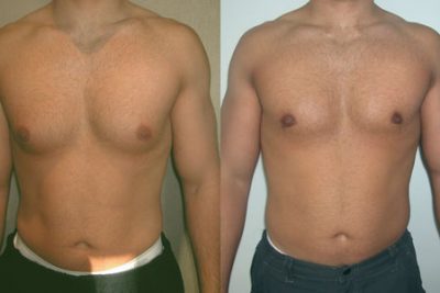 Another Natural Ways Male Breast Reduction Exercise