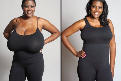 Breast Reduction Surgery Recovery