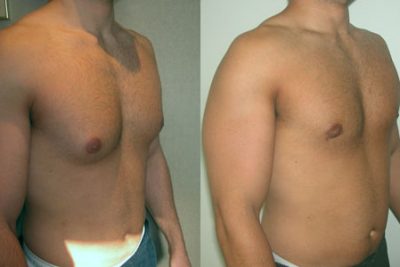How Much Male Breast Reduction Cost